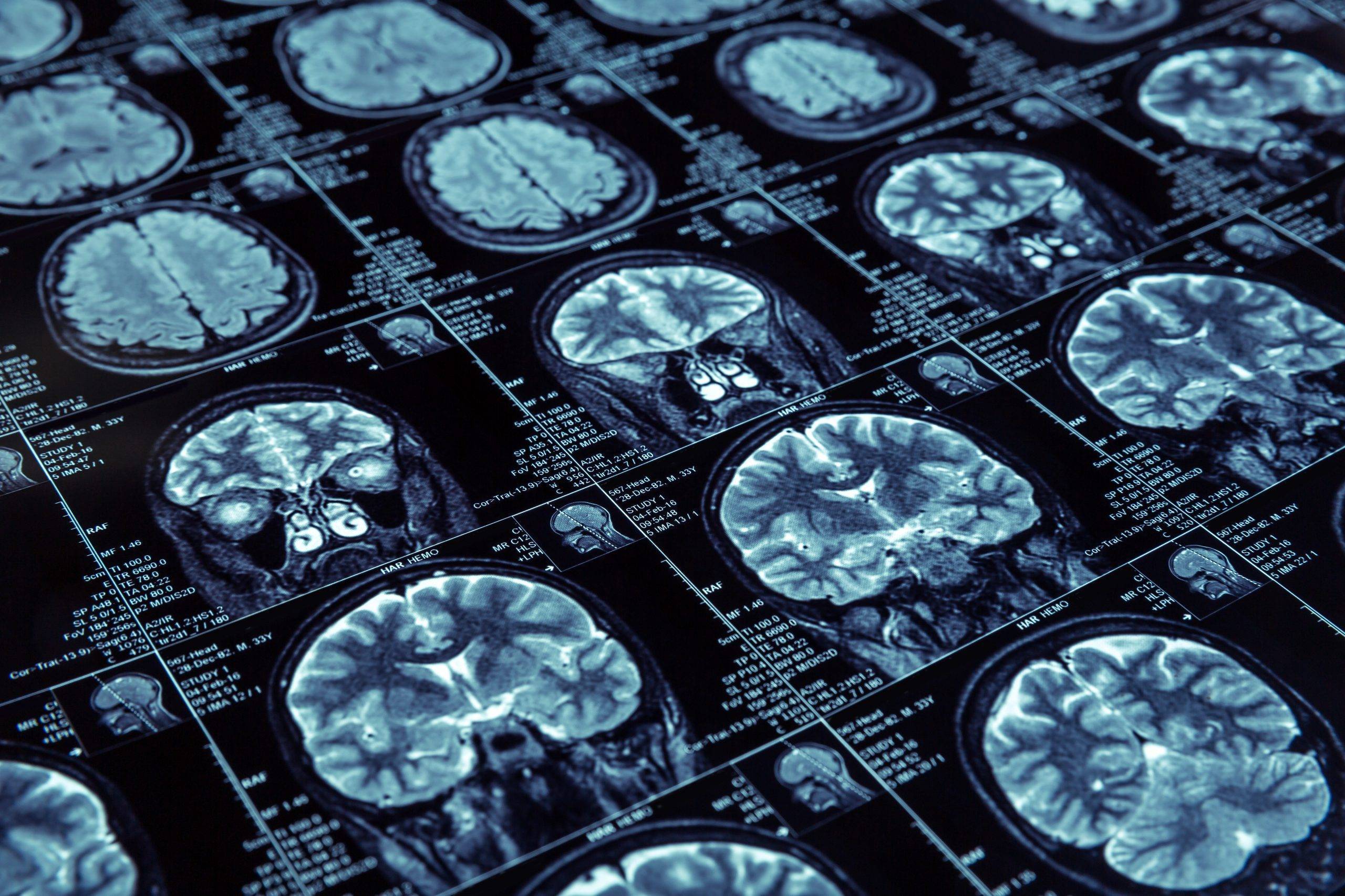 Magnetic resonance imaging Closeup of X-ray photography of human brain